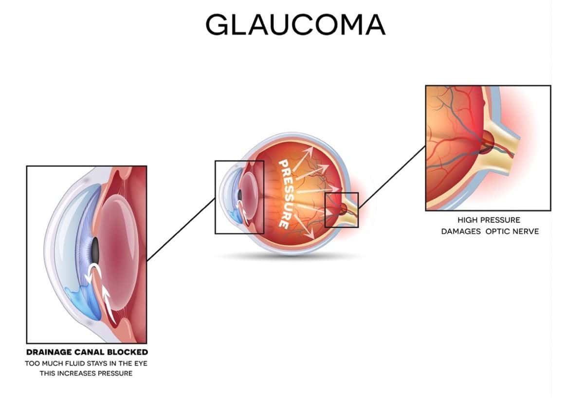 Image of glaucoma