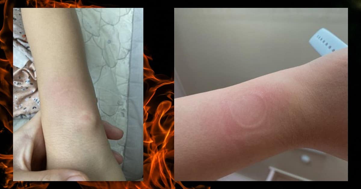 Apple Watch SE overheating has caused burned wrists