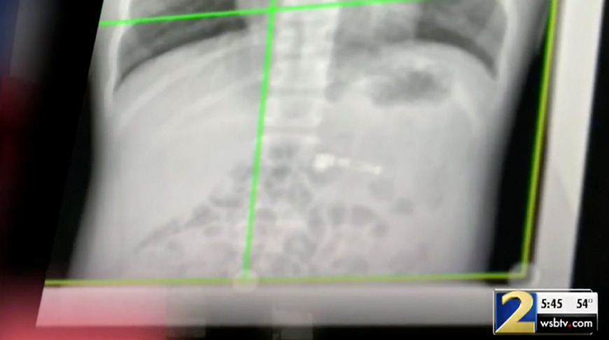swallowed airpod on x-ray