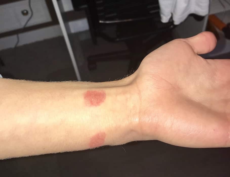 Reddening Burn Marks on the Wrist
