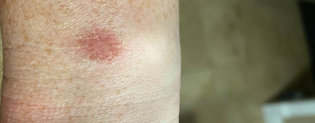 Skin Irritation and Rash on the Wrist